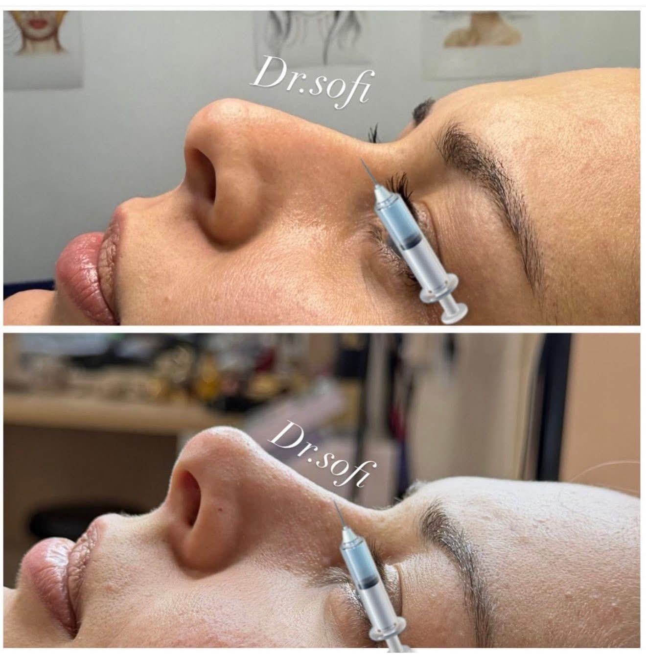 ცხვირის კორექცია